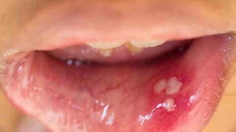 remedio caseiro para aftas