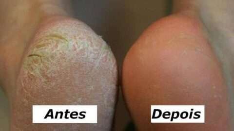 rachadura nos pés tratamento caseiro